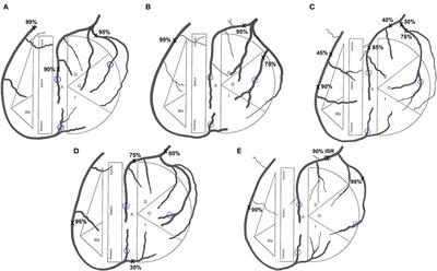 Personalized surgical planning for coronary bypass graft configurations using patient-specific computational modeling to avoid flow competition in arterial grafts